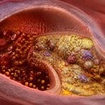 découvrez le rôle crucial du cholestérol ldl dans la formation des plaques d'athérome, un guide essentiel pour les professionnels de la santé visant à optimiser la prévention et le traitement des maladies cardiovasculaires.