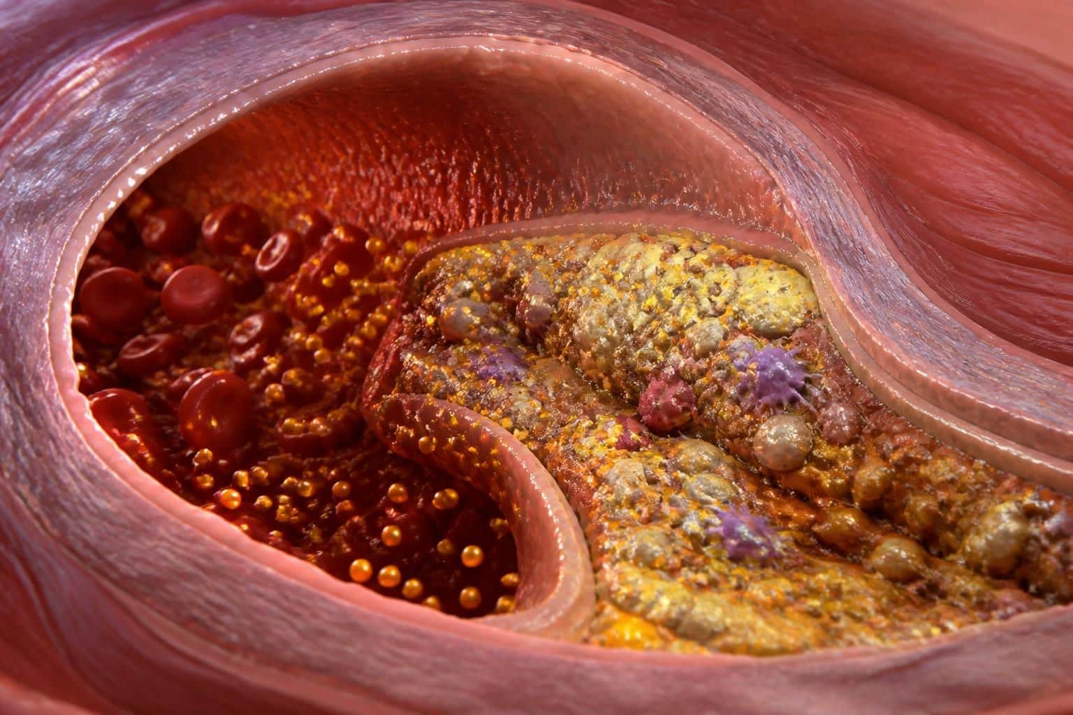 découvrez le rôle crucial du cholestérol ldl dans la formation des plaques d'athérome, un guide essentiel pour les professionnels de la santé visant à optimiser la prévention et le traitement des maladies cardiovasculaires.